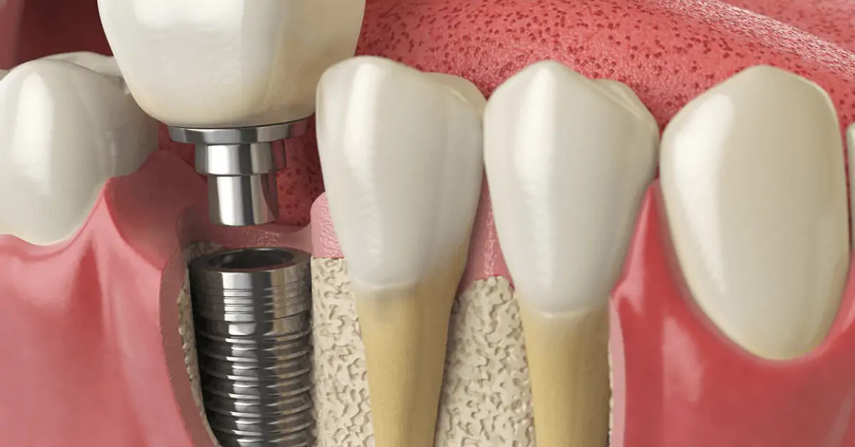 Kreative Dentistry - Dental Crown & Tooth Bridges