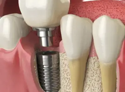 Dental Crown Tooth Bridges