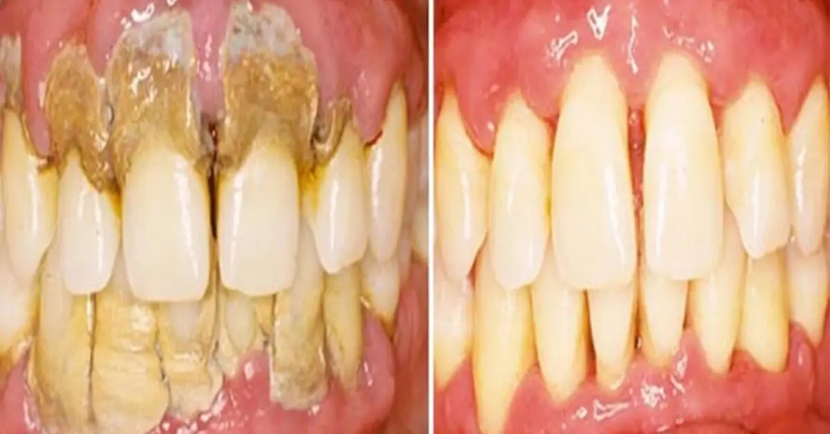 Kreative Dentistry - Pyorrhoea Surgery