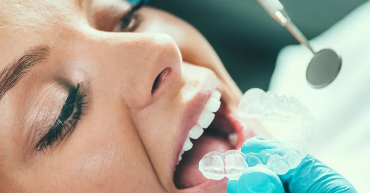 Kreative Dentistry - Teeth Whitening