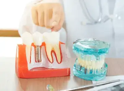 Kreative Dentistry - Dental Implant
