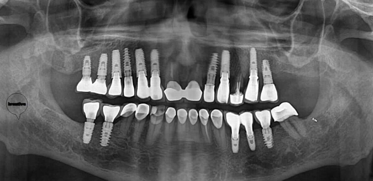 Basic Certification Course In Oral Implantology - Kreative Oral Surgery2