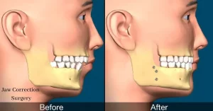 Jaw Correction Surgery