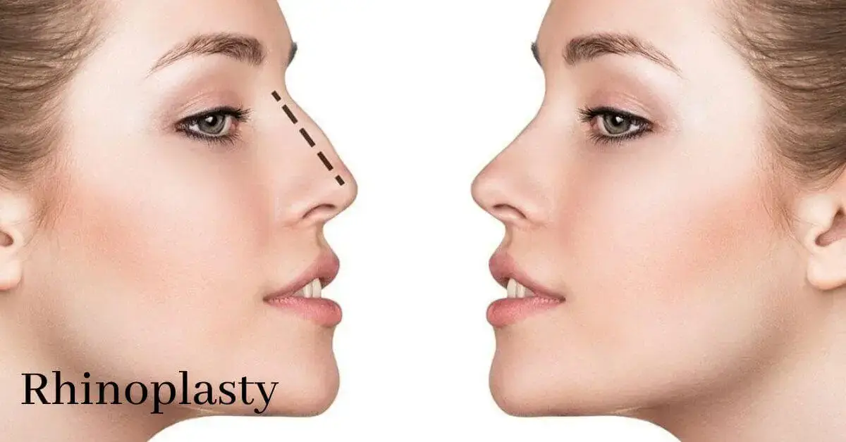 Rhinoplasty